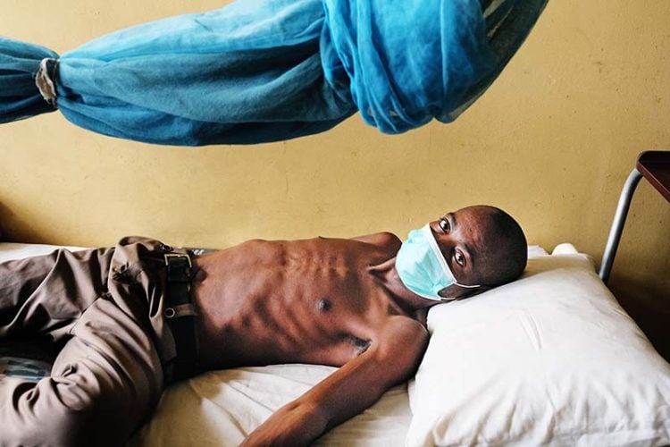 Tuberculosis.jpg